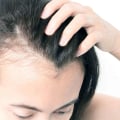 Clinical Nutrition And Artas Hair Transplant: A Perfect Combination For Hair Restoration In Danville