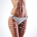 A Combined Approach: Clinical Nutrition And Liposuction For Lasting Results In Scottsdale